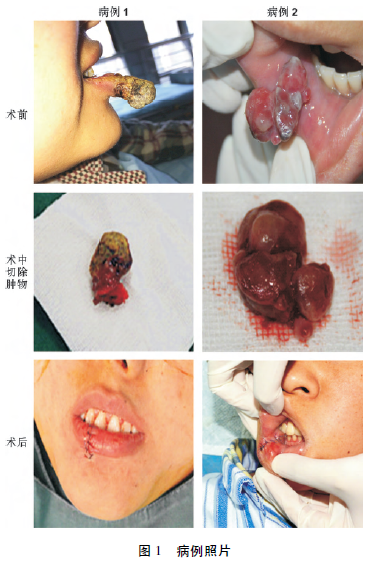 妊娠期下唇分叶状毛细血管瘤2例