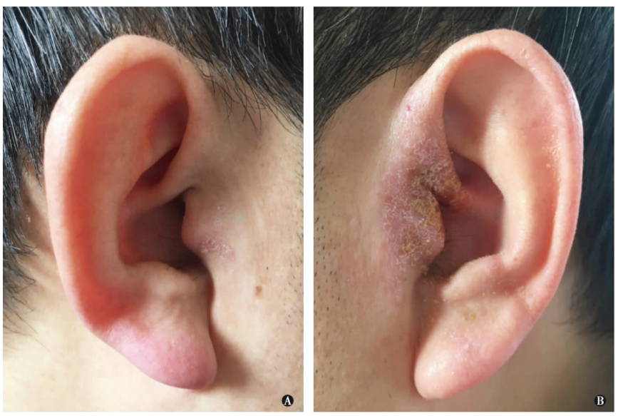 中耳胆脂瘤并发<font color="red">真菌</font>性外耳道炎及外耳湿疹 1 例