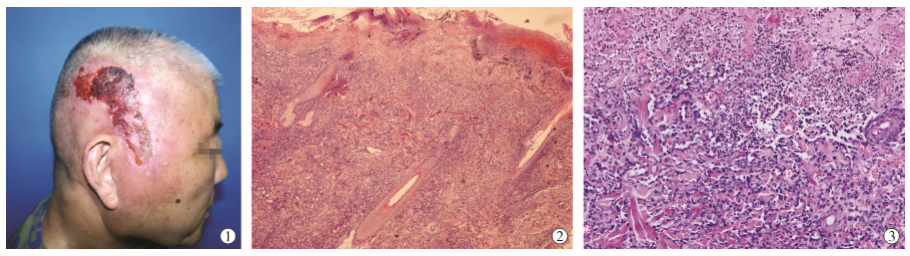 误诊为脂溢性皮炎的老年头面部血管<font color="red">肉瘤</font>1 例