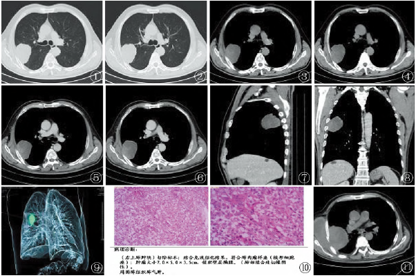 原发性肺<font color="red">肉瘤</font>样<font color="red">癌</font>的CT表现与鉴别诊断