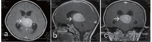 儿童松果体区脑膜瘤1例