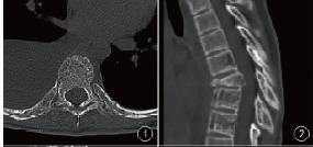 Gorham-Stout综合征累及多个胸椎、肋骨一例