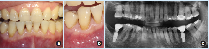 冠向复位瓣联合结缔组织瓣治疗下前牙牙龈退缩