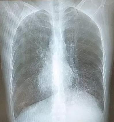 22岁男子咳嗽咳痰10余年，“右位心”提示这个病！