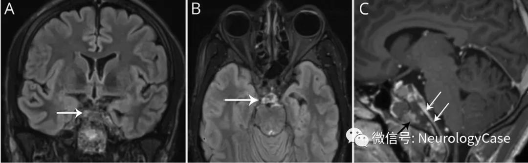 Neurology：斜坡梗<font color="red">死后</font>出现的颅神经麻痹病例