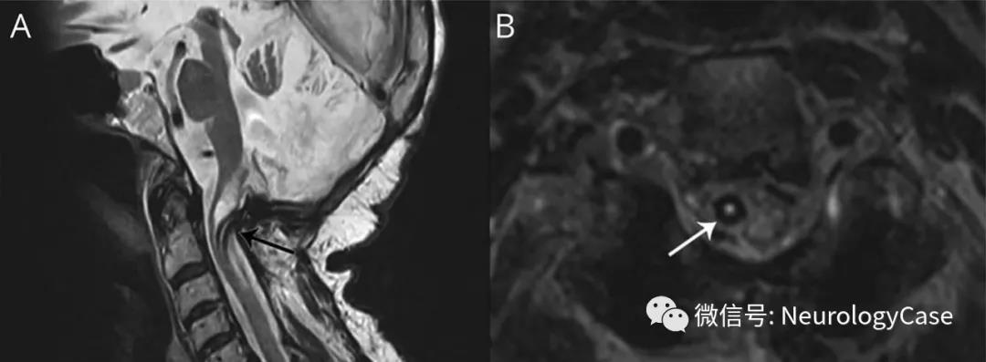 Neurology：被遗忘的Torkildsen分流管髓内移位所致的进行性<font color="red">颈</font><font color="red">髓</font>病