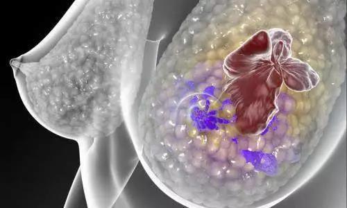 Sci Transl Med: 这些被<font color="red">忽视</font>的免疫细胞，竟是乳腺癌细胞治疗的“潜力股”！