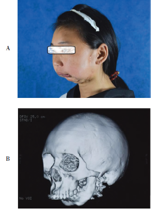 重度OSAHS伴严重小颌畸形患者行下颌骨牵张成骨术的麻醉管理1例
