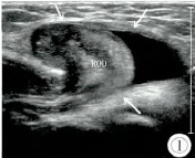 高频超声诊断女性婴幼儿腹股沟附件嵌顿疝2例