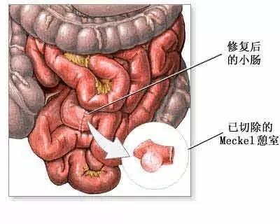 大腸 憩室 炎 原因