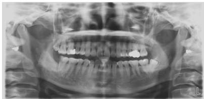 上颌第一磨牙牛牙症伴C型根管1例