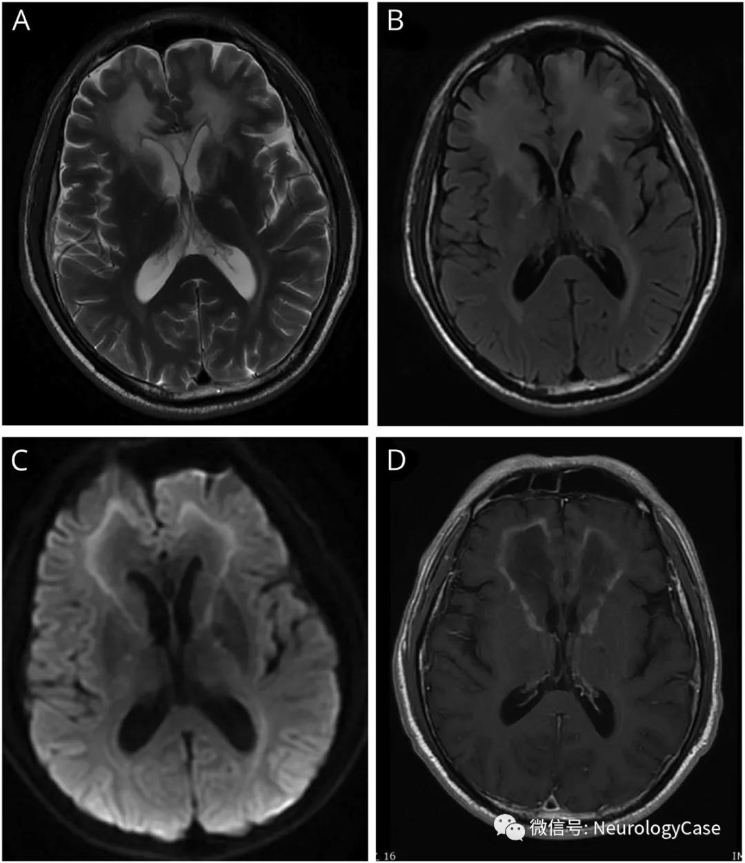 Neurology病例：见于成人起病的X连锁<font color="red">肾上腺</font>脑白质营养不良的额叶受累