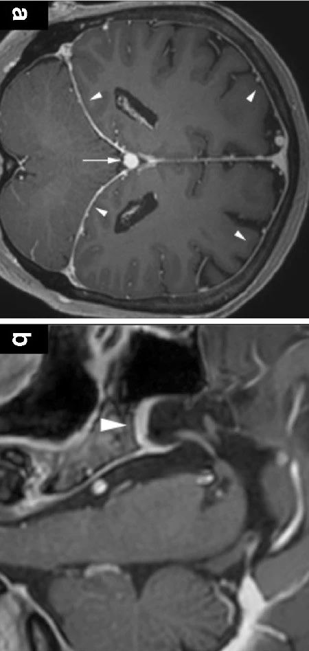 Neurosurgery：静脉窦<font color="red">支架</font><font color="red">治疗</font>自发性脑脊液鼻漏