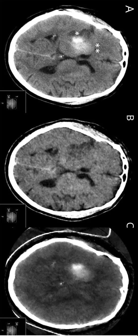 Neurology：双能 CT 鉴别出血和造影剂渗出
