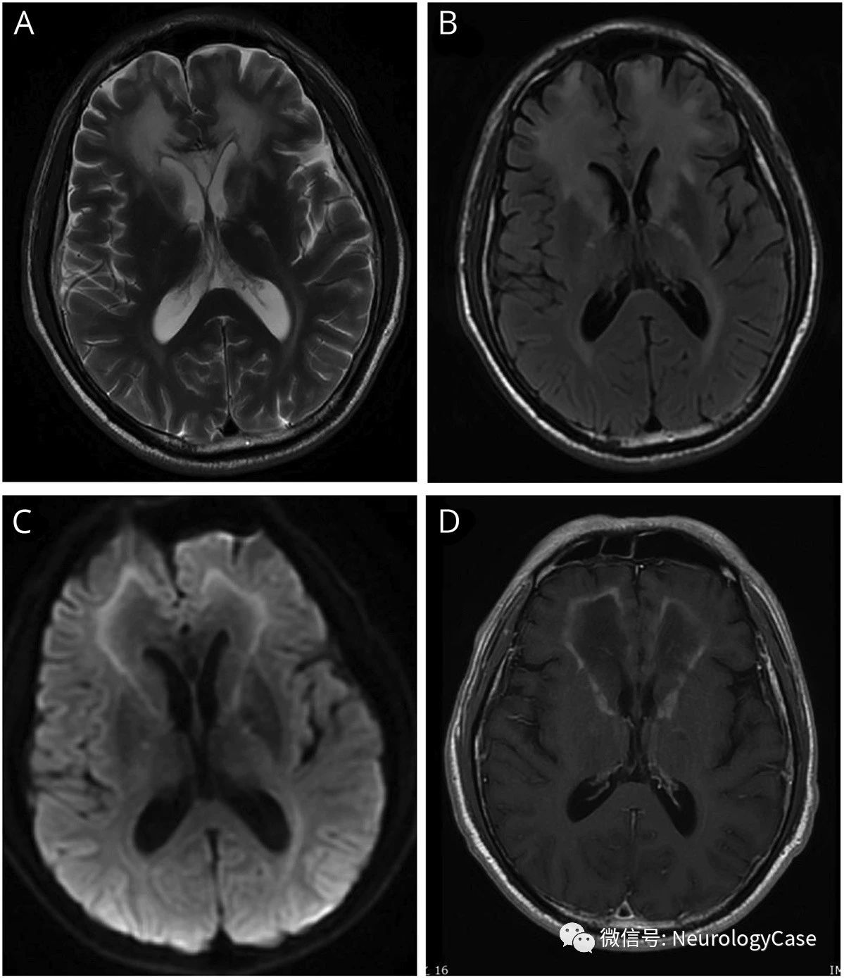 Neurology：见于成人起病的X连锁肾上腺脑白质营养不良的额叶受累