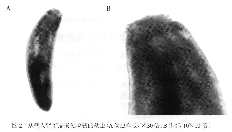 病例分享 | 一例颚口<font color="red">线虫</font>病的曲折诊疗史