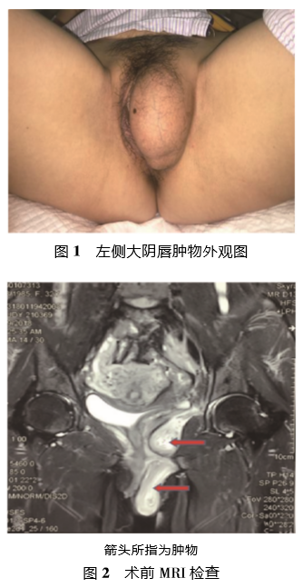 经腹膜外联合会阴完整切除侵袭性血管黏液瘤 1 例