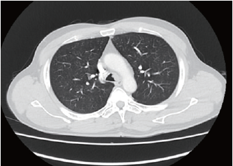 胸腔镜下<font color="red">气管</font>肿瘤切除加隆突成形术中气道管理一例