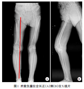 一期截骨矫形内固定联合导航引导下全膝关节置换术治疗伴有股骨关节外畸形的膝骨关节炎1例