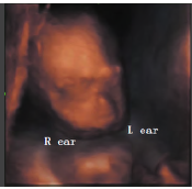 胎儿<font color="red">无</font>下颌并耳畸形超声表现1例