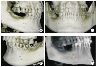 CBCT观察下颌骨双侧双副颏孔1例