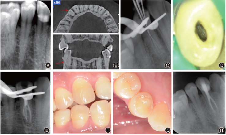 下颌第一前磨牙<font color="red">变异</font>根管的诊断和治疗4例