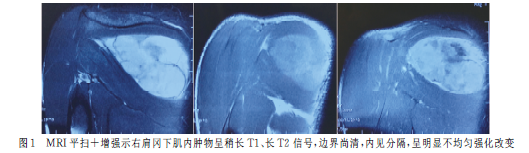右肩部多形性横纹肌肉瘤1例