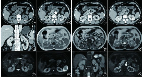 脾硬化性血管瘤结节性转化CT和MRI表现一例