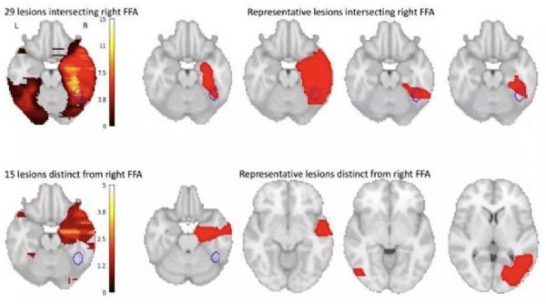 Brain：脸盲症竟与大脑损伤有关，可能为自闭症治疗提供线索