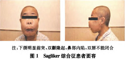 Sagliker综合征患者甲状旁腺切除术麻醉一例