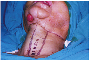舌鳞状细胞癌放疗后骨肉瘤1例