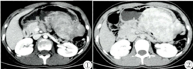 CT诊断儿童巨大胃间质瘤1例