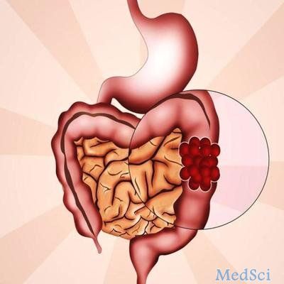 BMJ Open Gastroenterology：大肠癌的危险因素因解剖部位而异