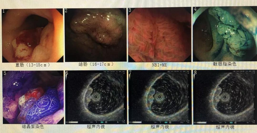 内镜下ESD及射频消融治疗食管及结肠病变