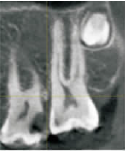 上颌第二磨牙根管上端弯曲伴MB21例