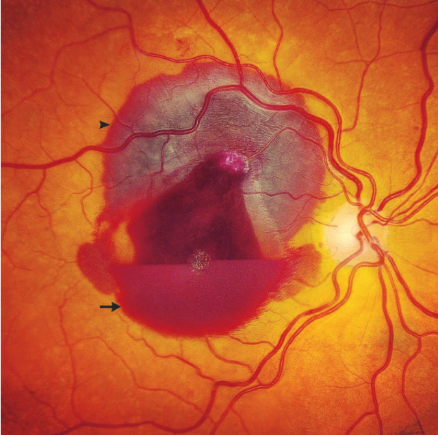 NEJM：钝性眼外伤引起的视网膜出血-病例报道