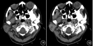 腮腺Mikulicz病CT及MRI表现（附8例<font color="red">报告</font>）
