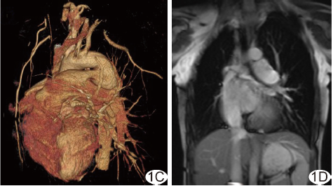 MSCT及MRI诊断先天性右肺动脉缺如伴动脉导管未闭1例