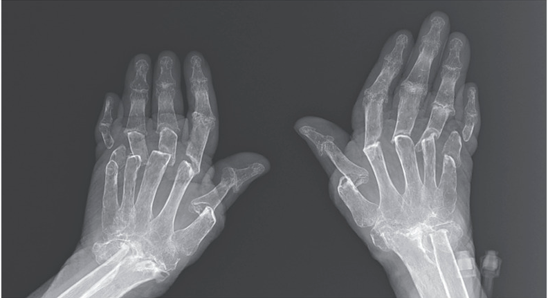 NEJM：类风湿关节炎患者的伸缩式手指-病例报道