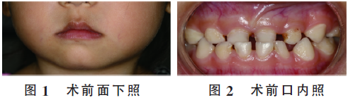 透明冠修复乳牙龋即刻纠正乳前牙反牙合1例病例报告