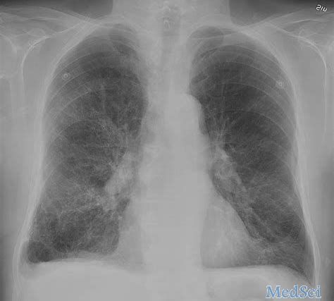 阿斯利康的三联疗法PT010在中国获批用于COPD患者
