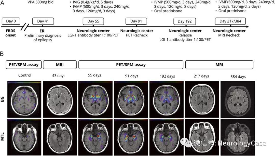 Neurology：LGI-1自身免疫性脑炎患者3个不同阶段的18F-FDG-PET/SPM分析