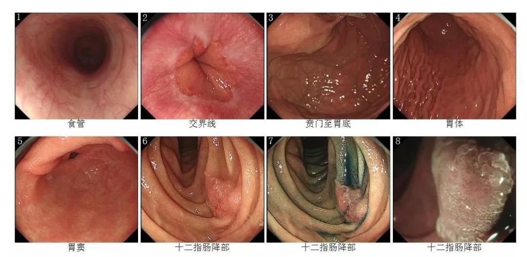 分享 ? 如何減少十二指腸癌及食管多發(fā)<font color="red">癌</font>的漏診？