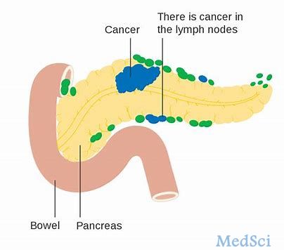 2020年ASCO胃肠道癌专题讨论会：多胺类似物SBP-101治疗胰腺癌