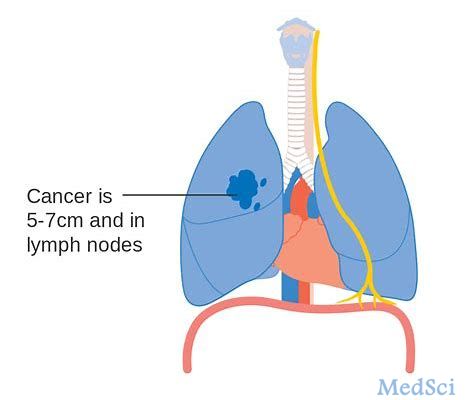 精准医疗的突破：FoundationOne CDx癌症基因组谱可用于Rozlytrek治疗ROS1阳性肺癌的伴随诊断