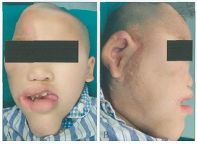 面部先天性浸润性脂肪增殖症伴发癫痫1例