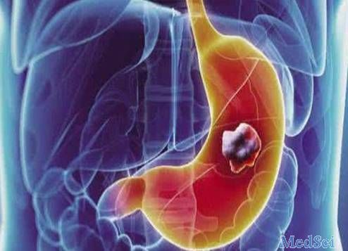 Gastric Cancer：糖尿病与患胃癌的风险增加有关