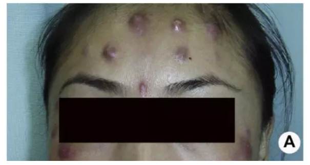 病例：罕见并发症肉毒毒素注射后继发皮肤感染