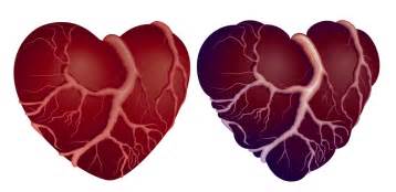 Stroke：加拿大研究：首次卒中后患者30天内新发心脏病风险升高20多倍