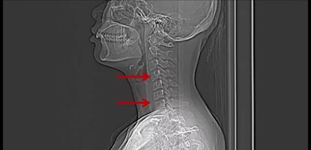 颈椎CT天天看，这位27岁上班族的颈椎CT你看懂了吗？